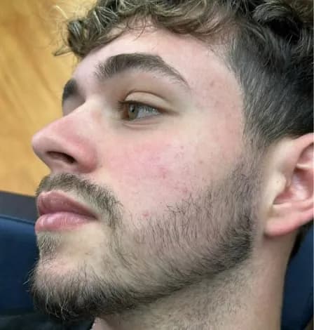 Perfil masculino com barba mais definida depois do procedimento