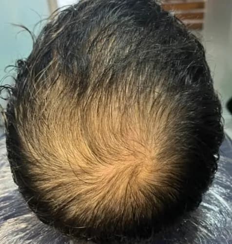 Topo da cabeça antes da nanopigmentação, com o couro cabeludo aparente
